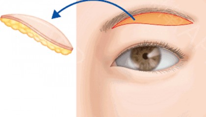 真相：提眉手术有风险和后遗症吗、提眉手术风险大吗